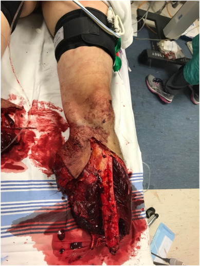 Clean and Dress the Wound - Handling Severe Bleeding and Wound Care