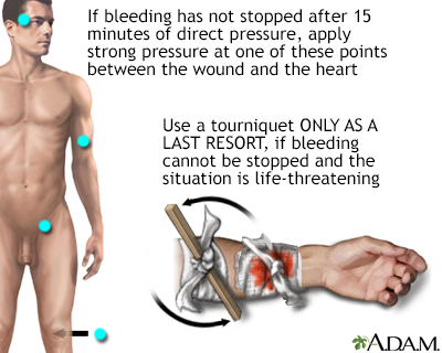 Use a Tourniquet (As a Last Resort) - Handling Severe Bleeding and Wound Care