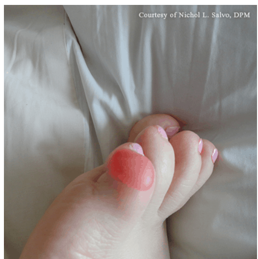 Never pop blisters. - First Aid Essentials: What to Do in Common Emergencies