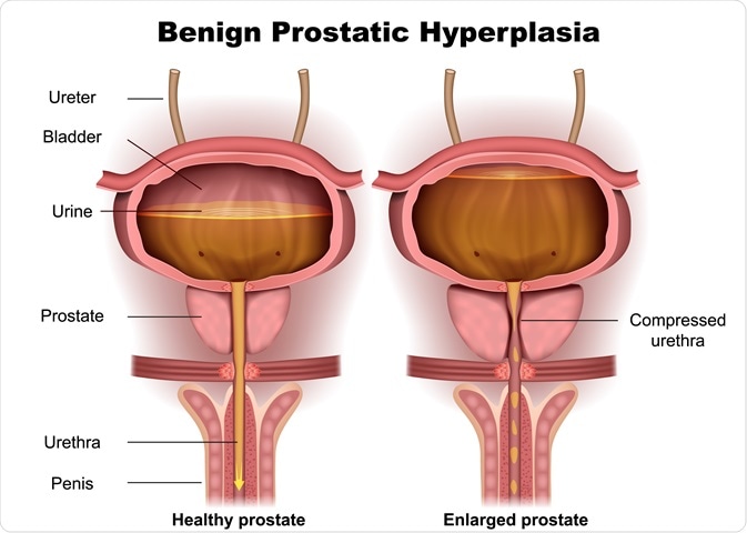 Benign Prostatic Hyperplasia (BPH): - Guarding Your Prostate Health: Preventing Prostate Problems